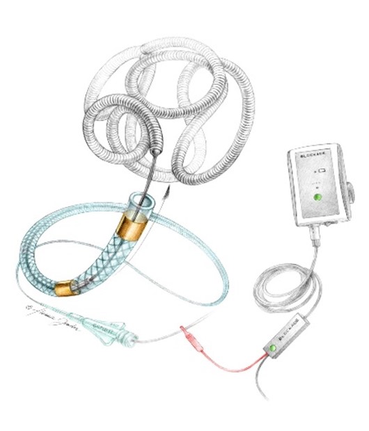 Barricade Embolization Coil System