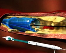 PROTEUS™ PTA Balloon Catheter with Embolic Capture Feature