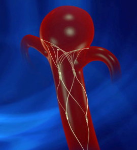 PulseRider Aneurysm Neck Reconstruction Device